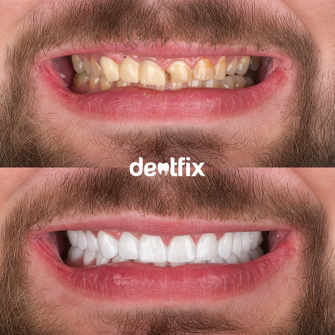 before & after